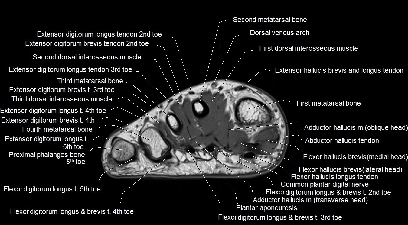 MRI 3T foot axial cross sectional anatomy image 24.webp